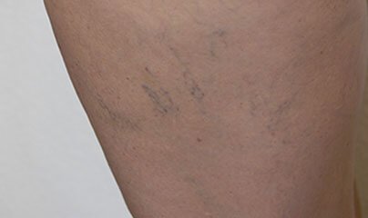 Laser couperose et varicosité chez Spa Jouvence Laser couperose et varicosité chez Spa Jouvence